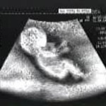 Novità in Texas e Sud Dakota: ecografia obbligatoria e 72 ore prima di abortire