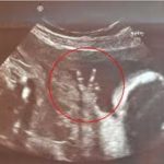 Il progresso scientifico contro l’aborto: oggi si opera un feto umano di 20 settimane 