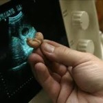 Spagna, fallito “l’aborto libero”: aumentano le interruzioni di gravidanza