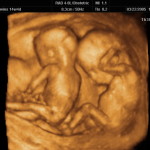 Gli abortisti in affanno osteggiano l’uso dell’ecografia 4D