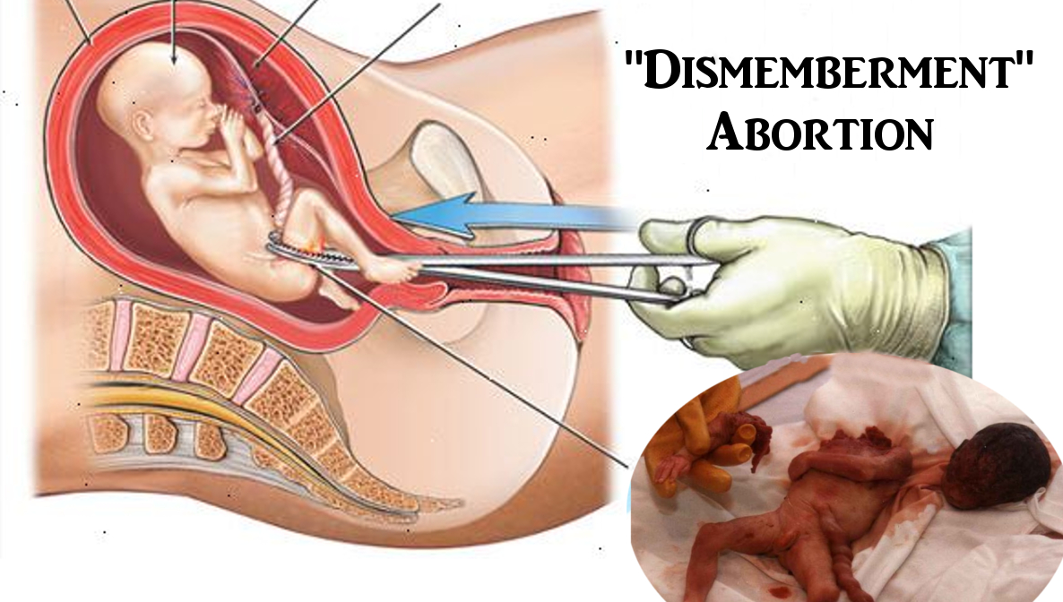 aborto smembramento divieto